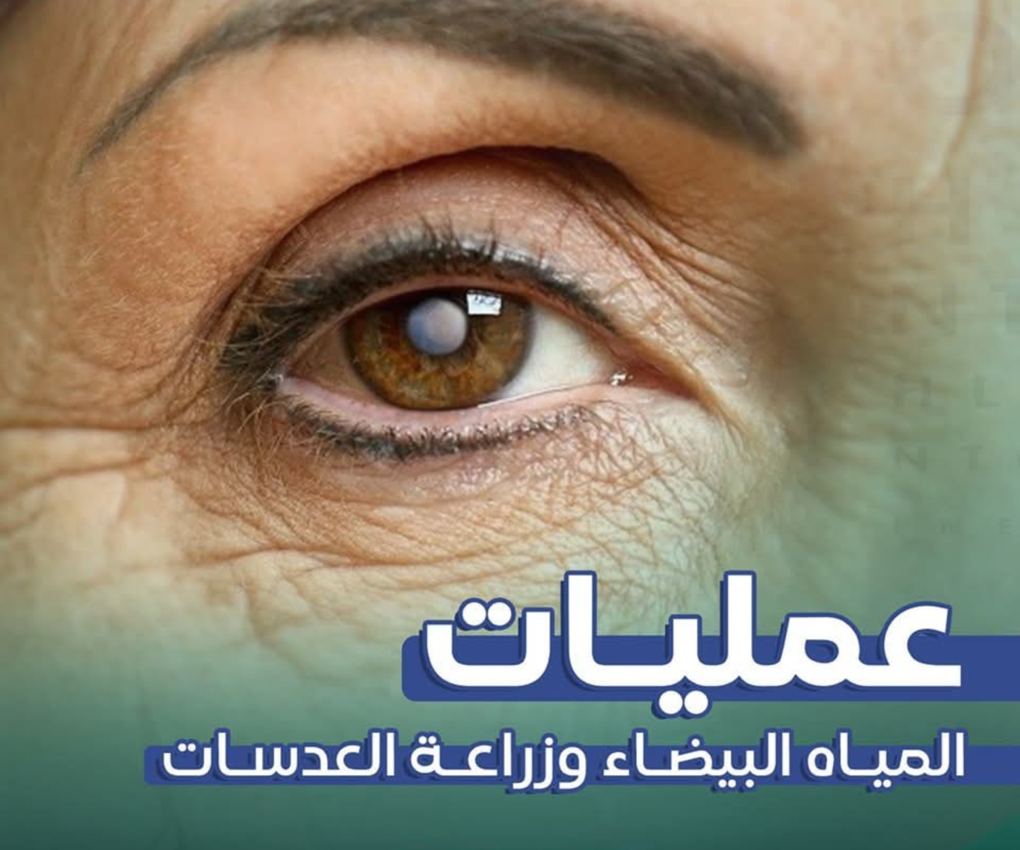 جراحة المياه البيضاء وزراعة العدسات