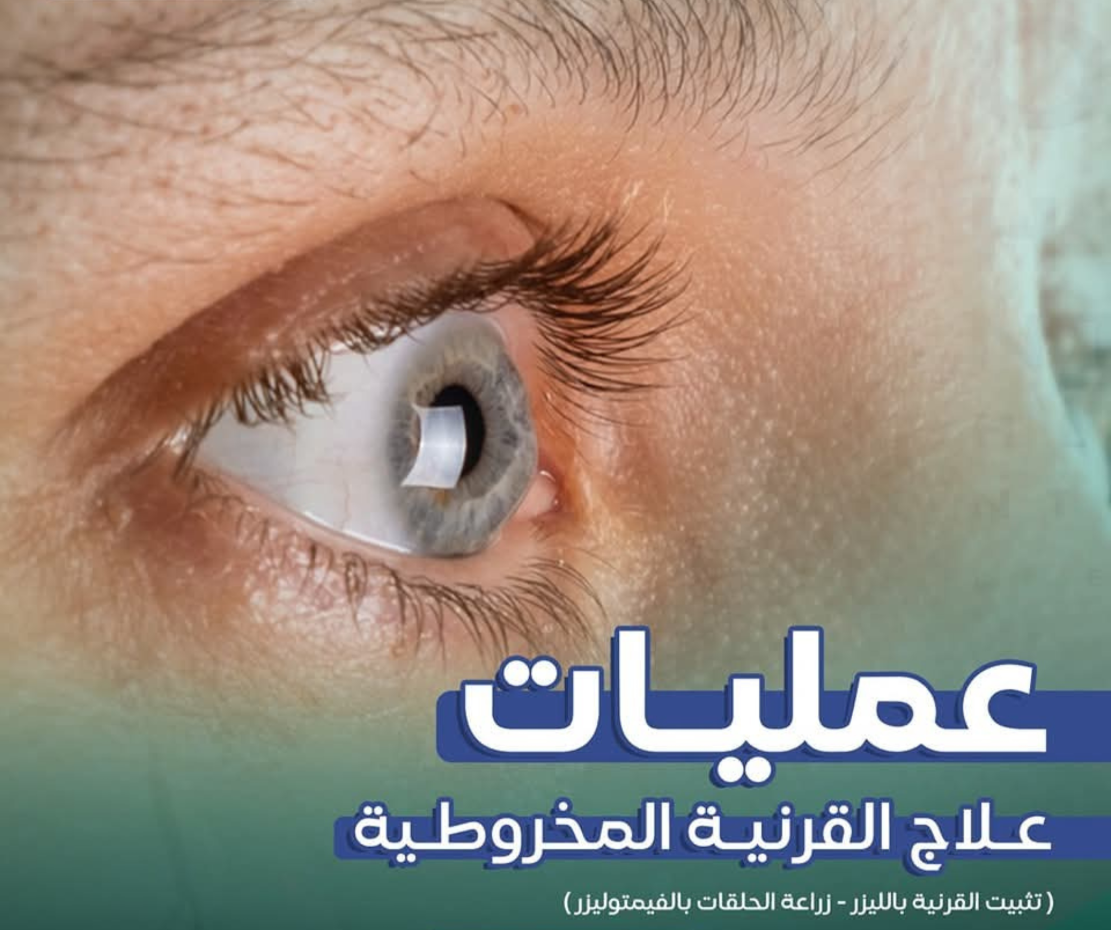 علاج القرنية المخروطية وتثبيت القرنية